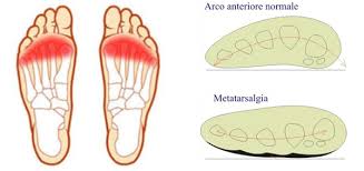 Cedimento dell'arco plantare anteriore dell' osso metatarsale