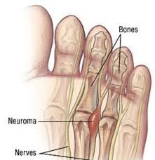 NEUROMA/ITE DI MORTON. Si tratta di una sindrome canalicolare simile alla più nota sindrome del tunnel carpale